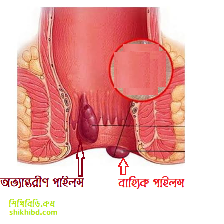 পাইলস কত প্রকার